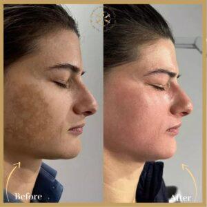Microneedling With PRP