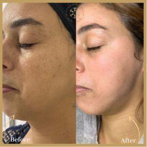 Microneedling With PRP