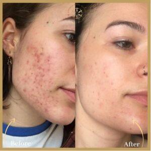 Microneedling With PRP