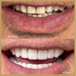 Laser Teeth Whitening