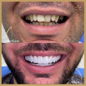 Laser Teeth Whitening