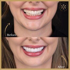 Laser Teeth Whitening