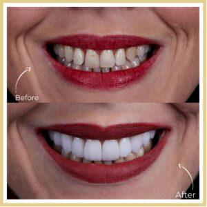 Dental Veneers in islamabad