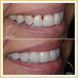 Dental Veneers in islamabad