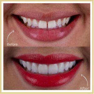 Dental Veneers in islamabad