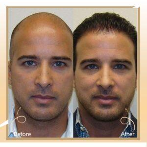 FUT Hair Transplant in Islamabad