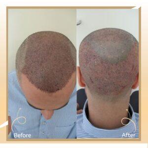 FUT Hair Transplant in Islamabad