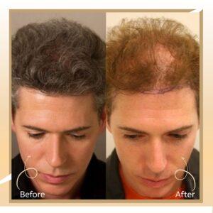 FUT Hair Transplant in Islamabad
