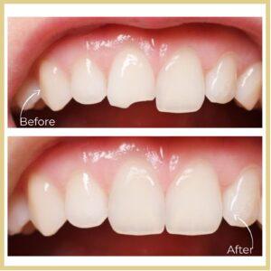Fractured Teeth Treatment