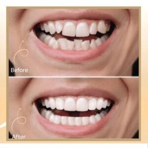 Lingual Braces in Islamabad