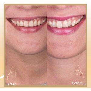 Lingual Braces in Islamabad