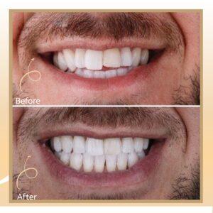 Lingual Braces in Islamabad