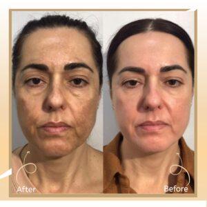 Mesotherapy for Face & Skin
