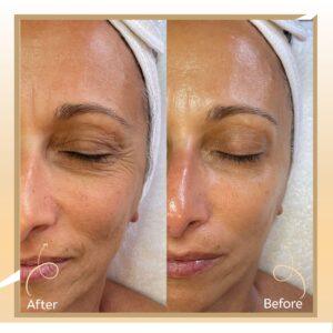 Mesotherapy for Face & Skin