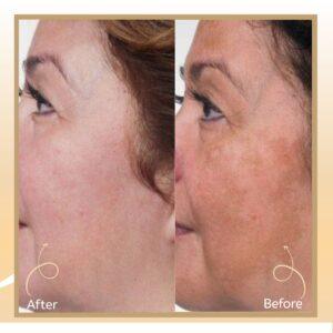 Mesotherapy for Face & Skin