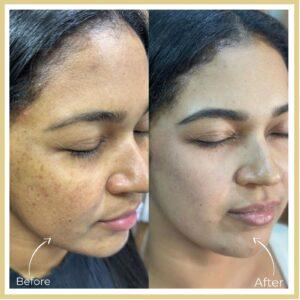 Skin Whitening Treatment