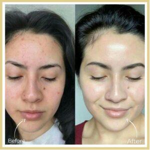 Skin Whitening Treatment after before