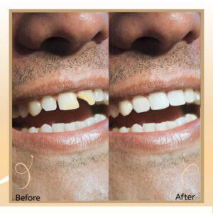 teeth filling in islamabad, rawalpindi & pakistan