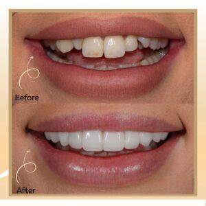 teeth filling in islamabad, rawalpindi & pakistan