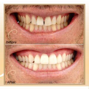 teeth filling in islamabad, rawalpindi & pakistan