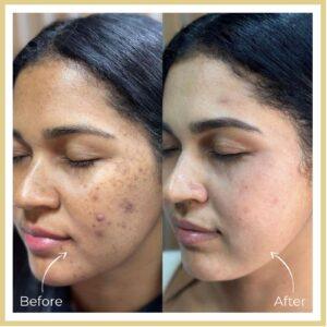 Yellow peel treatment