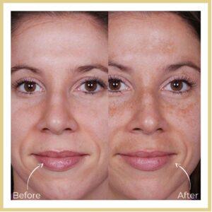 Yellow peel treatment after before