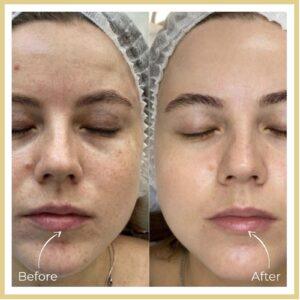 Yellow peel treatment before after