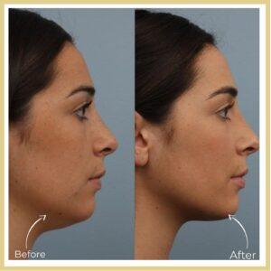 chin reduction in islamabad after before