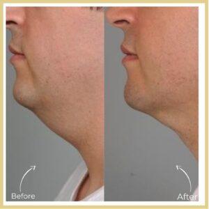 chin reduction in islamabad beore after