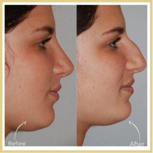 closed rhinoplasty in islamabad