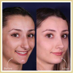 Rhinoplasty in Islamabad - best nose reshaping