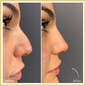 closed rhinoplasty in islamabad