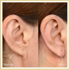 earlobe treatment in islamabad after before