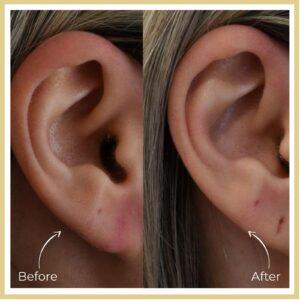 earlobe treatment in islamabad after before