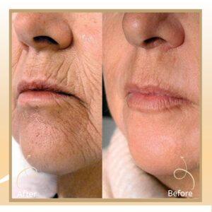 Laser Skin Tightening in Islamabad