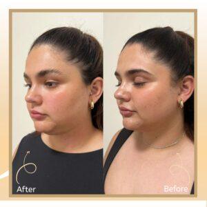 Laser Skin Tightening in Islamabad