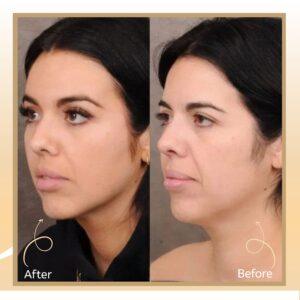 Laser Skin Tightening in Islamabad