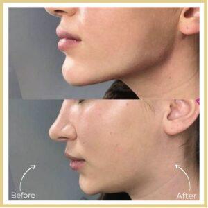 neck liposuction after before