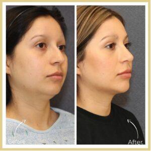 neck liposuction before after