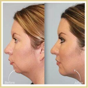 neck liposuction in islamabad