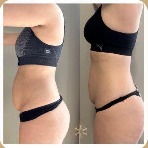 liposuction in Islamabad