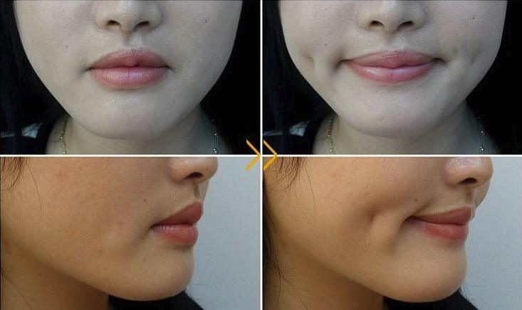 Dimple Creation - Dimpleplasty