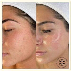 Pico Laser Treatment