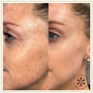 Pico Laser Treatment before after