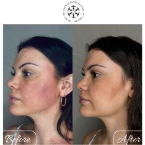 hyperpigmentation treatment in islamabad