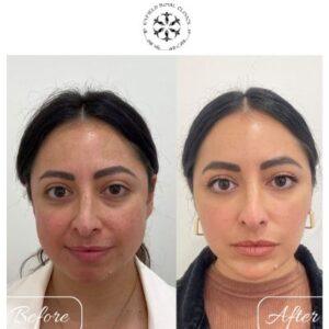 hyperpigmentation treatment in islamabad