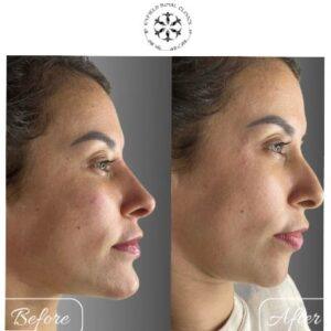 hyperpigmentation treatment in islamabad